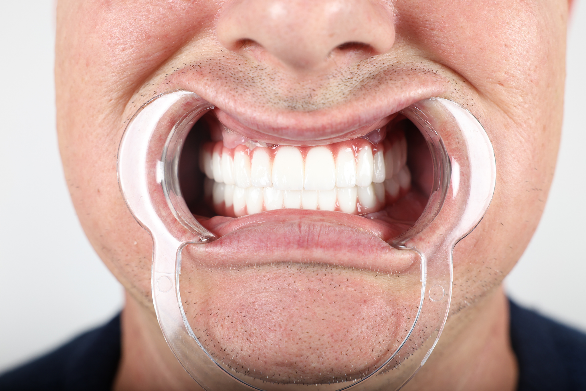 After All-on-6 Implant Treatment